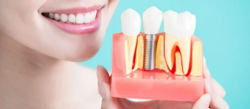 5 Reasons That Make Dental Implants So Popular