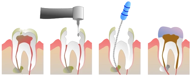 Best way to do Root Canal Treatment