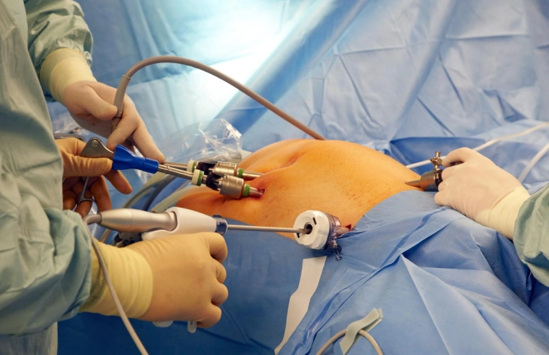 Hire The Experienced Team For Gastric Sleeve Surgery Sydney