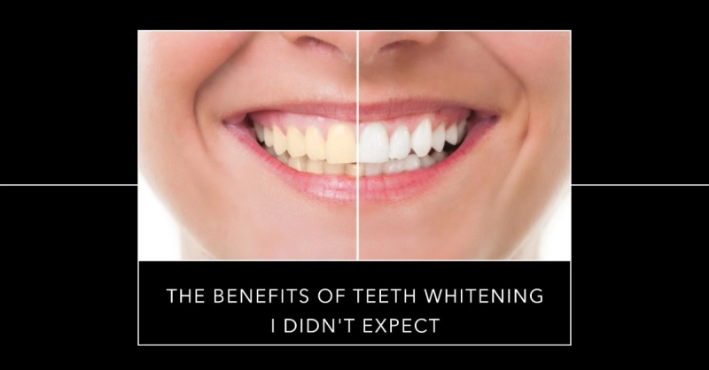 The Benefits Of Teeth Whitening I Didn't Expect