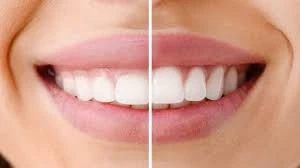 What Do You Know About The Gingivectomy Procedure?