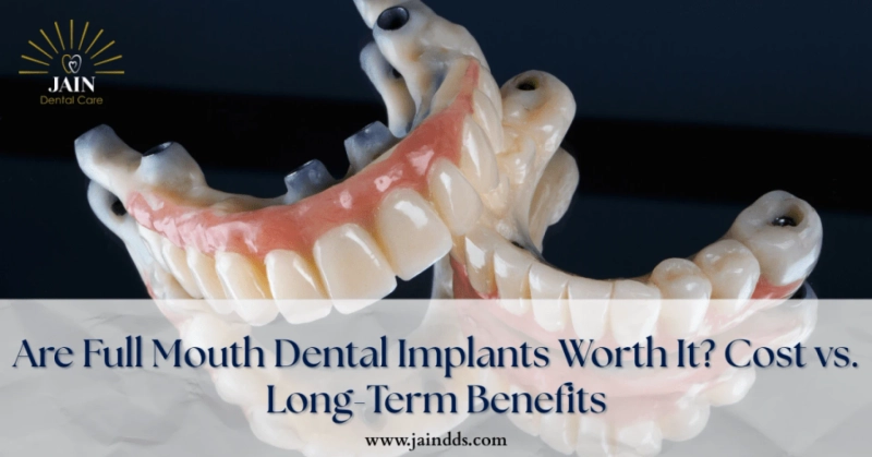 Full-Mouth Dental Implants: Why the Investment Often Pays Off