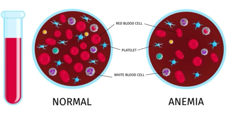 A Holistic Approach: Pranic Healing to Address Anemia Symptoms