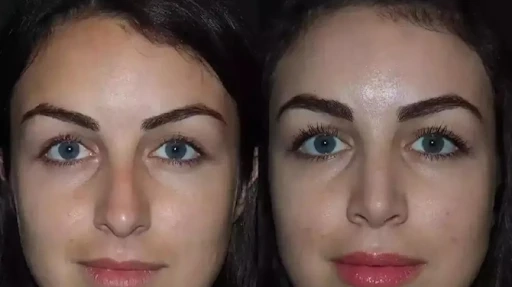 Rhinoplasty in Dubai: Before and After Success Stories