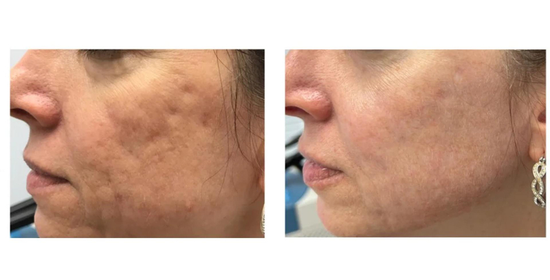 Fraxel vs. Clear+Brilliant: Which Laser Treatment Is Right for You?