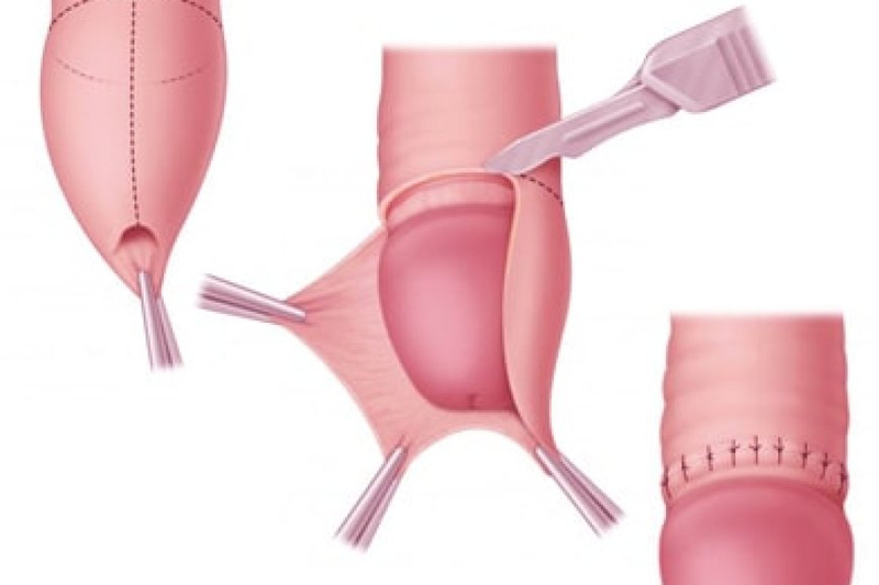 Dr. Niren Rao, The Founder Of Delhi Urology Hospital, Offers Circumcision Surgery in Delhi