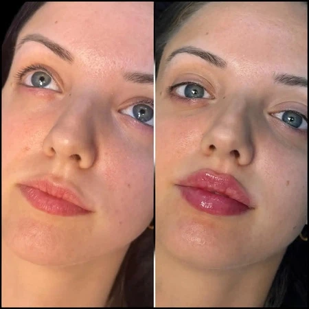 Fillers Treatments in Dubai: A Quick Guide to Instant Glow