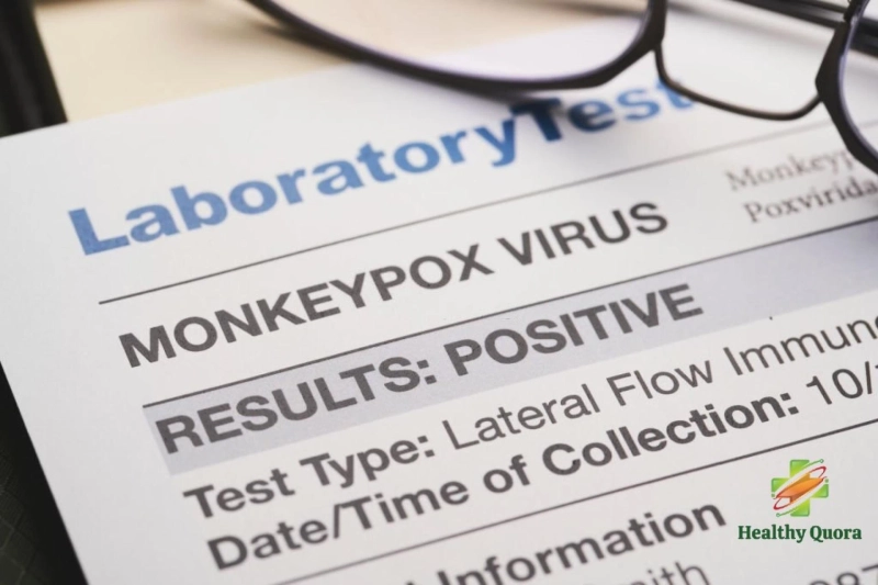 How do you cure monkeypox? Get answer on HealthyQuora