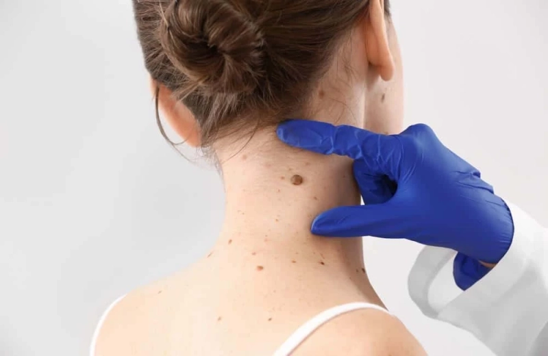 Dubai's Exclusive Skin Tag Removal Solutions Unveiled
