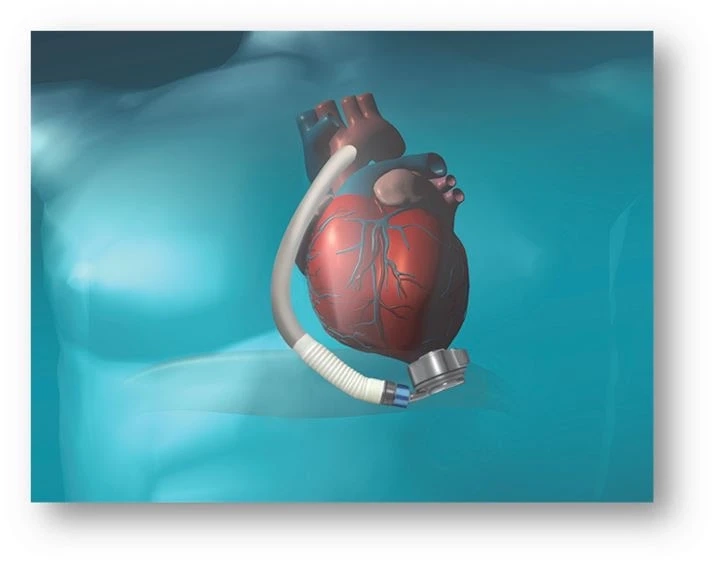 Cardiac Assist Devices Market to Reach US$1.37 Billion by 2023, Exhibiting a CAGR of 6.1%