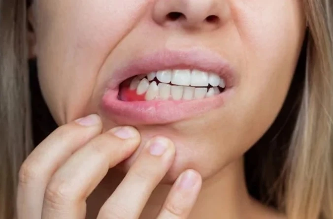 Why Do My Gums Bleed When I Brush?