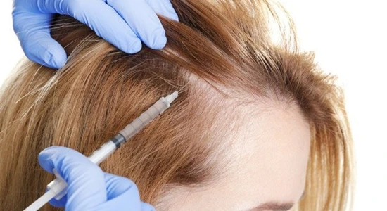 PRP for Hair Loss: How Platelet-Rich Plasma Can Restore Hair Growth