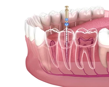 What Are the Root Canal Treatment and How It's Work?