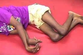 Speech and Language Therapy for Spastic Quadriplegic Cerebral Palsy