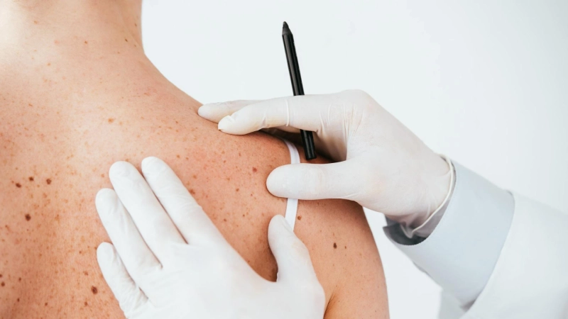 Treat Skin Cancer Disease with Conventional Therapies