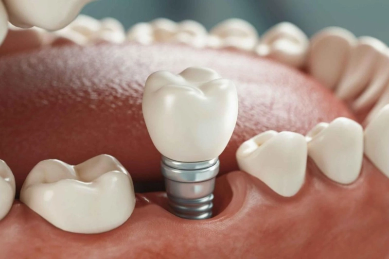Maintain Dental Implants for lifetime | Pearl Dental Surgery