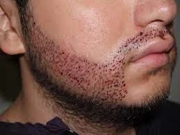 Get the Perfect Beard with a Hair Transplant