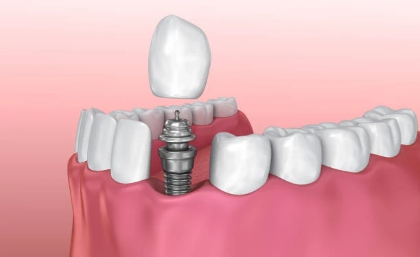 Are Single Tooth Implants Worth the Investment?