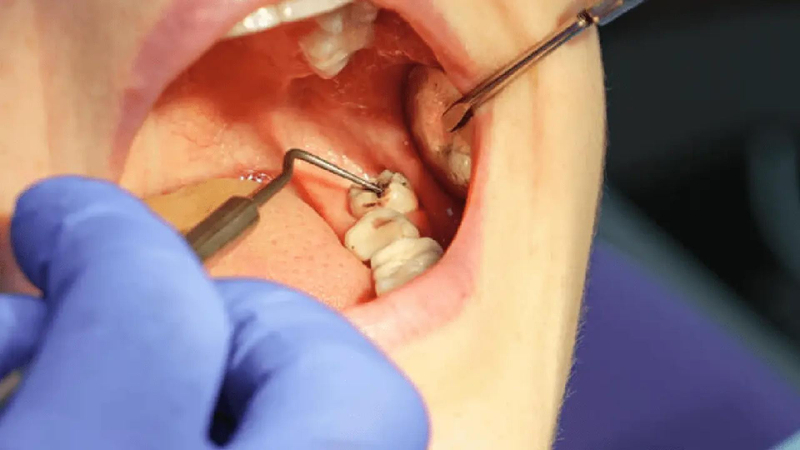Swelling After Wisdom Tooth Removal: What’s Normal & When to Worry