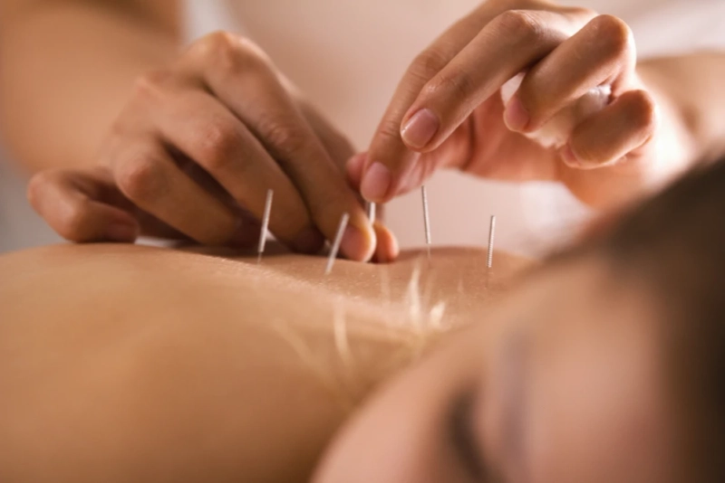 Traditional Chinese Acupuncture in Edmonton for Modern Stress Relief