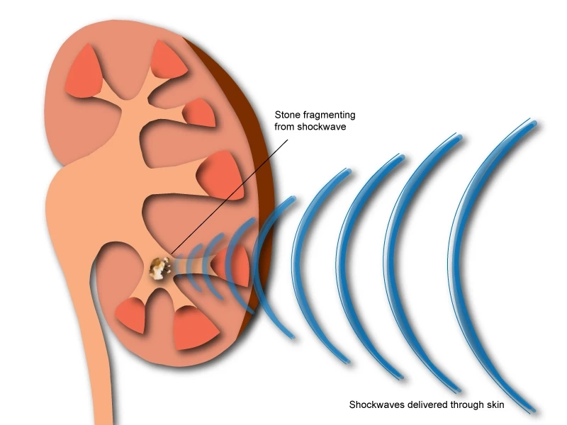 Shock Wave Lithotripsy: A Non-Invasive Solution for Kidney Stones