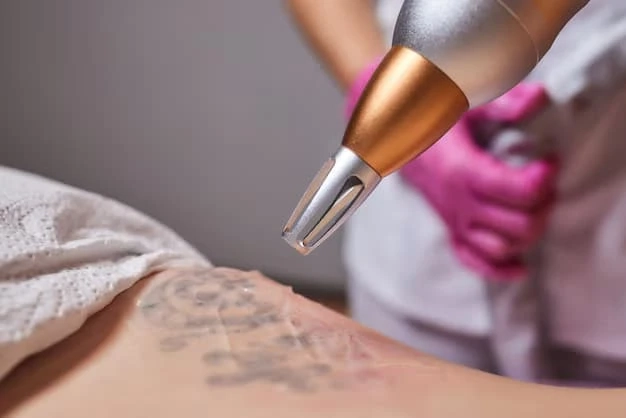 How Laser Tattoo Removal in Glasgow Works and What Results to Expect