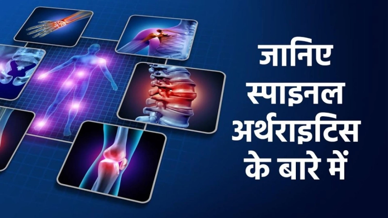 Spinal Arthritis है खतरनाक, जाने कारण, लक्षण और उपाय | Spinal Arthritis Treatment
