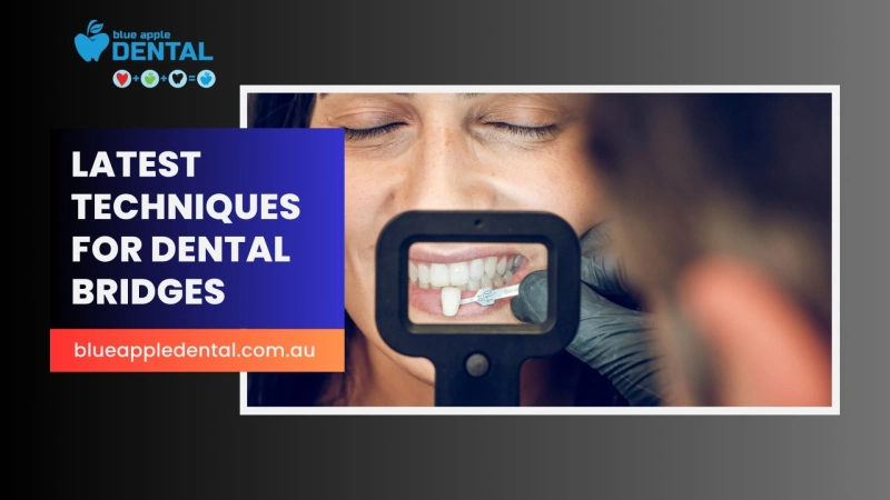 Latest Techniques For Dental Bridges