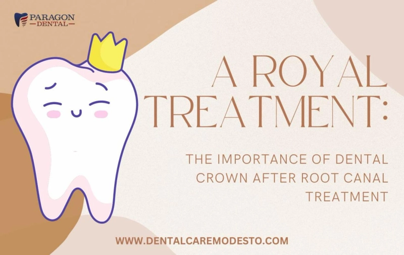 The Importance of Dental Crown After Root Canal Treatment