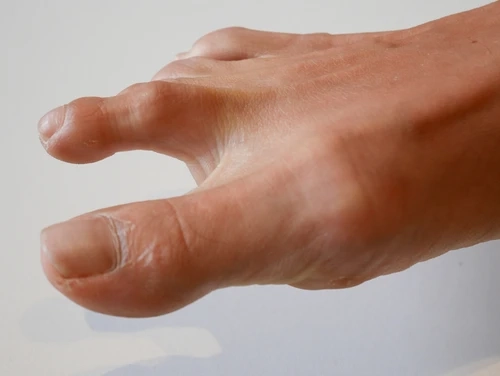 Hammer Toe Exercises: Professional Guide to Relief and Recovery