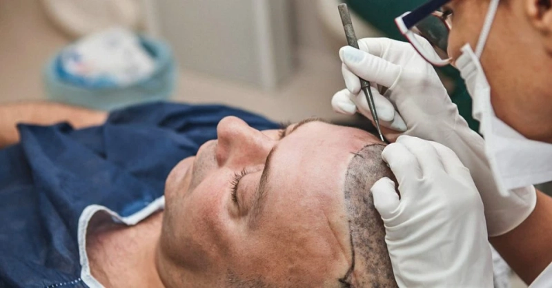 How To Get Ideal Hair Transplant Treatment in Ajmer?
