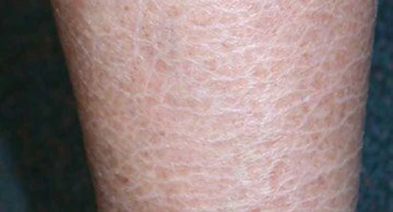 Global Fish Skin Disease Market Is Estimated To Witness High Growth Owing To Increasing Awareness Regarding Fish Health