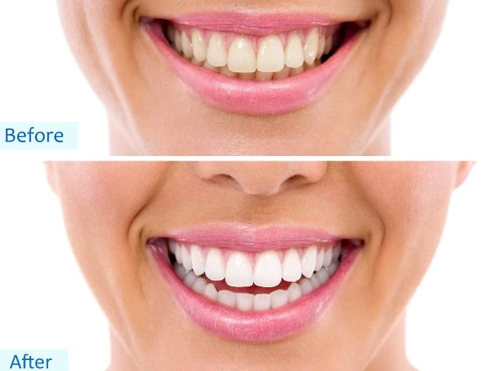 How Can You Prepare for Teeth Whitening for the Best Possible Results?