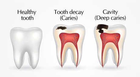 How Dental Decay May Cause Serious Health Problems