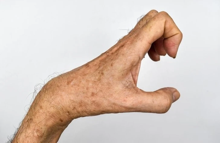 Non-Surgical Treatment for Dupuytren's Contracture: A Promising Path to Relief
