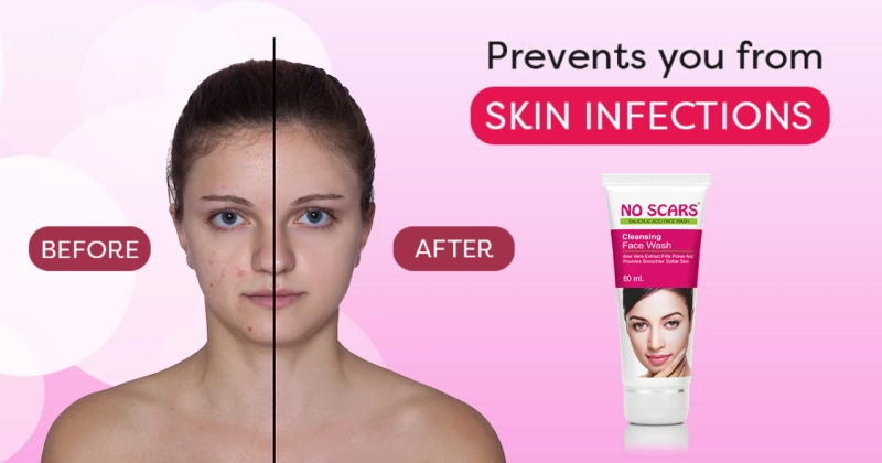 The best face wash for dark spots and acne is easily available these days