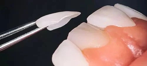 Achieving a Perfect Smile with the Best Veneers in Beverly Hills