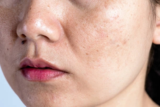 Sun Damage and Pigmentation Treatment: How to Protect Your Skin and Avoid Further Damage