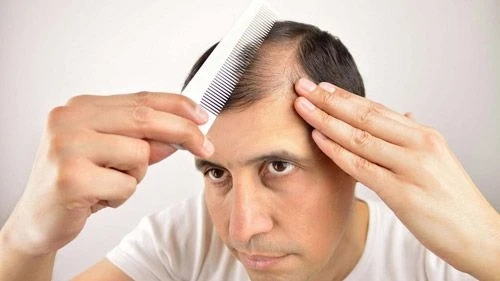 REASONS WHY YOU NEED HAIR SPECIALIST DOCTOR FOR HAIR LOSS