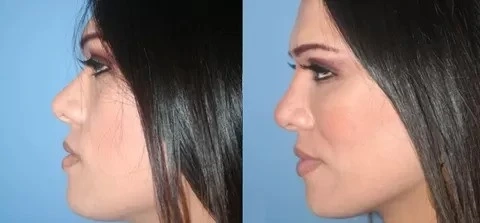 The Rise of Chin Fat Transfer Procedures in Dubai