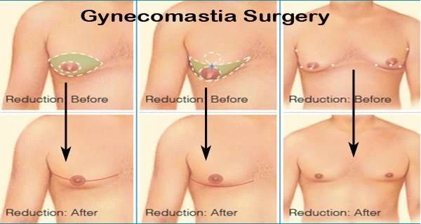 Breast Implant and Liposuction treatment In Kolhapur