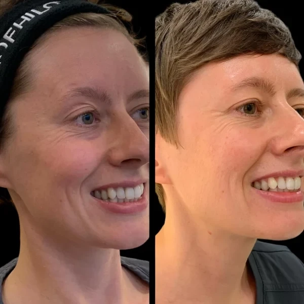 Profhilo Treatment in Dubai for Targeted Skin Revitalization