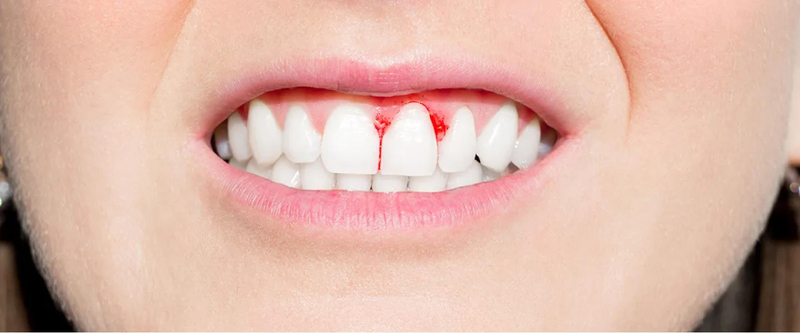 Is Gum Bleeding Treatment Always Necessary?