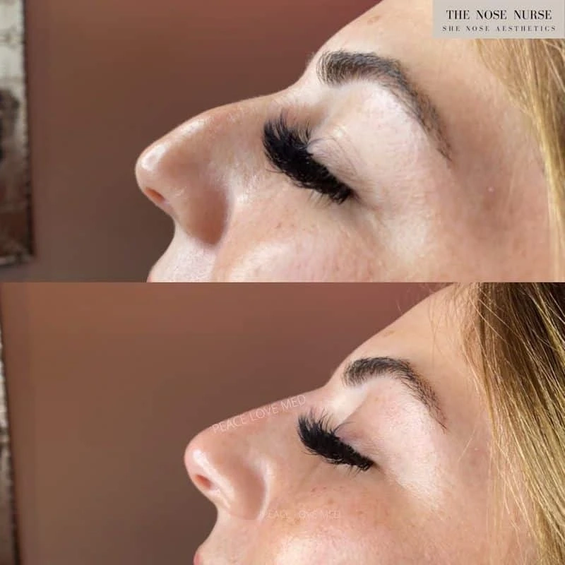 The Many Benefits of Non Surgical Nose Job Before and After