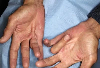 My brother and father have Dupuytren’s Disease. What are the chances I will get it too?