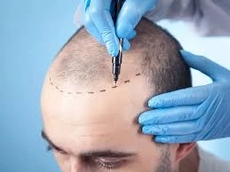 Risks associated with robotic versus manual FUE hair transplant?