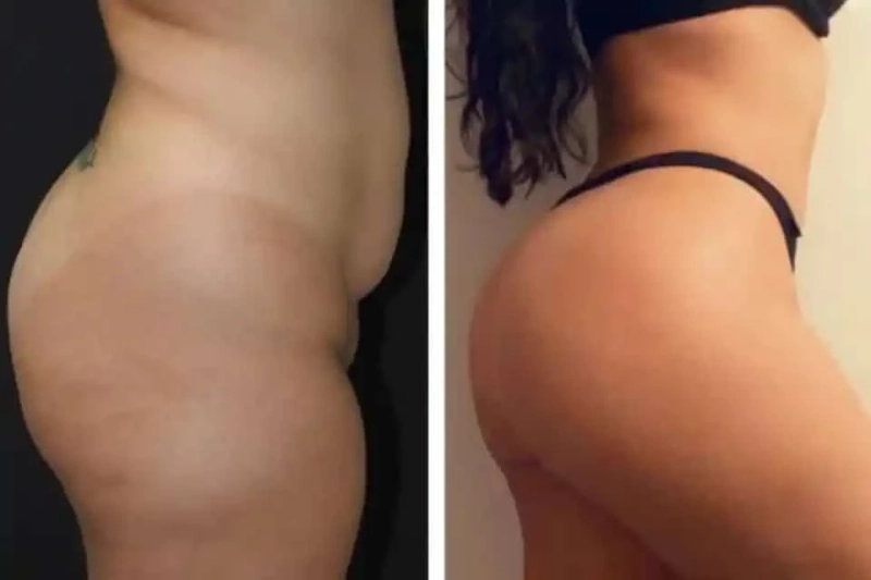 Liposuction and Body Confidence: Unveiling the Transformation in Dubai