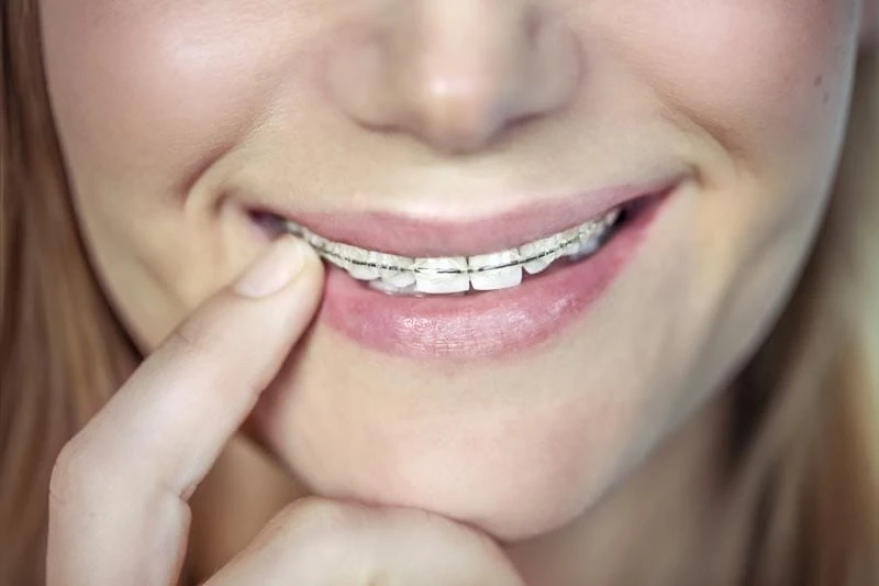 Different Kinds of Dental Braces