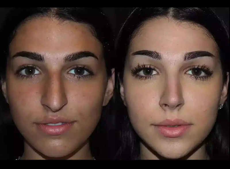 Can Septoplasty in Dubai Help with Chronic Snoring?