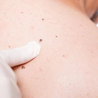 Experience Flawless Skin with Dubai's Best Skin Tag Removal